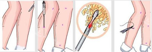 吸脂方式图片