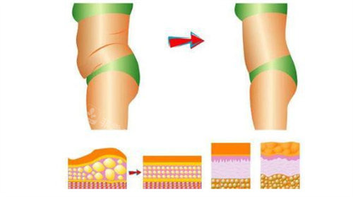 吸脂瘦腰腹前后对比图