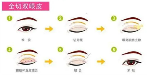 全切雙眼皮流程圖 全切雙眼皮流程圖
