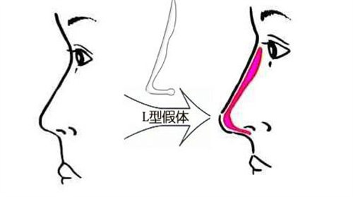 L型假體動(dòng)畫(huà)展示圖 L型假體動(dòng)畫(huà)展示圖