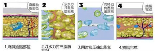 水動(dòng)力吸脂過程圖