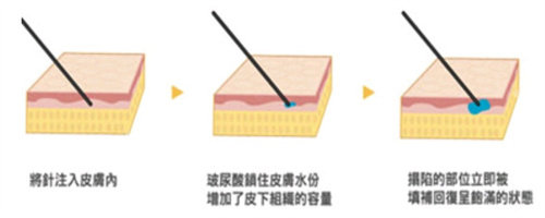 玻尿酸注射皮肤变化图 玻尿酸注射皮肤变化图