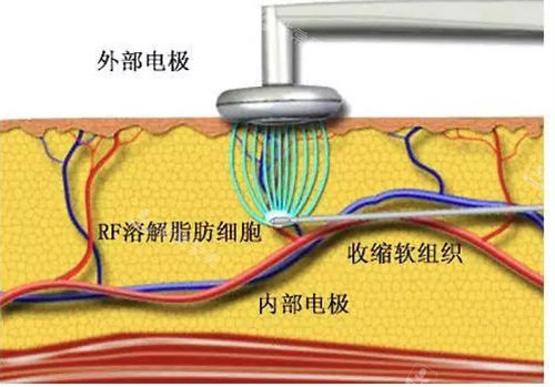 威塑吸脂原理是什么？和传统的吸脂有什么区别？