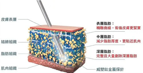 威塑吸脂原理是什么？和传统的吸脂有什么区别？