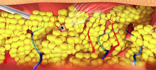 威塑吸脂原理是什么？和传统的吸脂有什么区别？