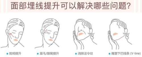 埋線提升可以解決的問(wèn)題