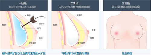 韓國MD整形胸再造手術方式