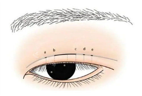 五点定位双眼皮展示图