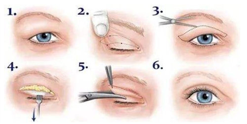 全切双眼皮流程图