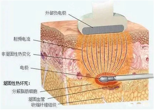 传统吸脂器图片