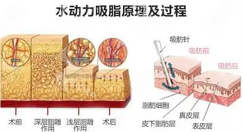 土麦森吸脂是什么技术？揭晓土麦森吸脂和水动力吸脂区别