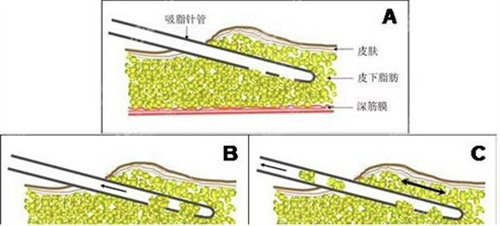 吸脂示意图