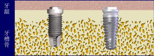 种植牙图片