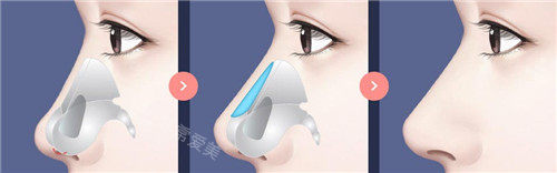 韩国TS整形外科鼻部整形过程图