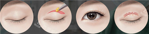 韩国TS整形外科眼部手术过程图