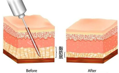 脂肪层图片