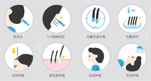 剃發(fā)植發(fā)流程展示圖 剃發(fā)植發(fā)流程展示圖