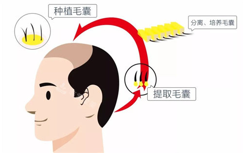 種植毛囊流程圖 種植毛囊流程圖