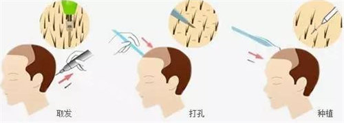 毛囊提取過程圖 毛囊提取過程圖