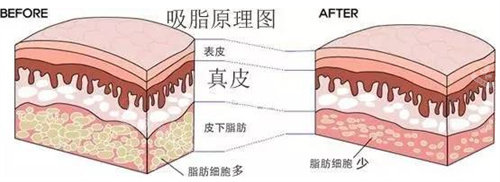 吸脂原理圖