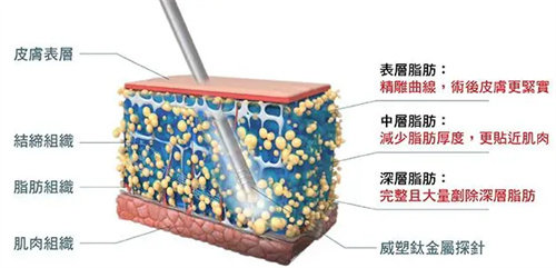 面部吸脂怎么样，会不会导致面部皮肤松弛？