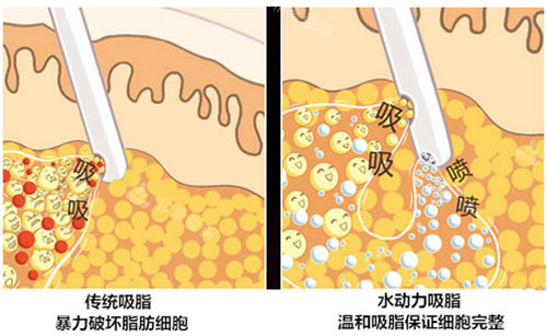 吸脂手術(shù)方式圖