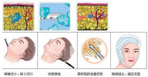 吸脂手术方式图