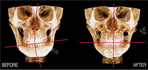 韩国菲斯莱茵整形双颚手术ct照