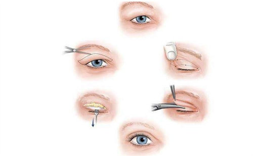 双眼皮修复手术流程图