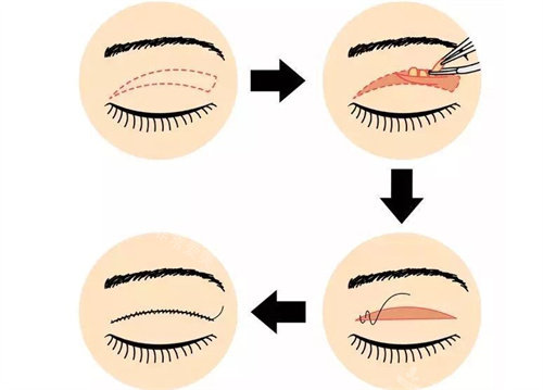 全切双眼皮操作展示图