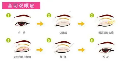 全切雙眼皮流程圖 全切雙眼皮流程圖
