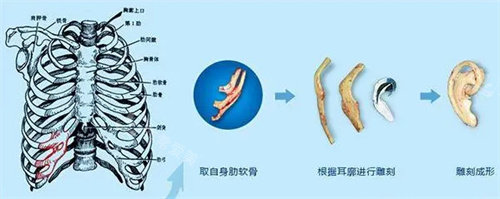 耳再造流程图 耳再造流程图