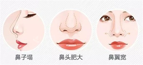 鼻部形态展示图 鼻部形态展示图