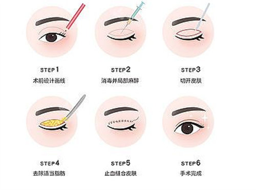 全切双眼皮流程图 全切双眼皮流程图