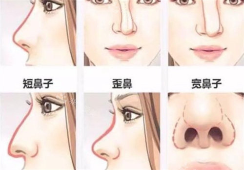 鼻子的多种形态图