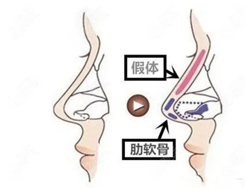 肋软骨隆鼻动画图