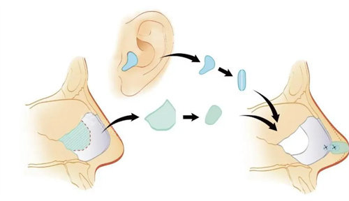耳软骨隆鼻流程图