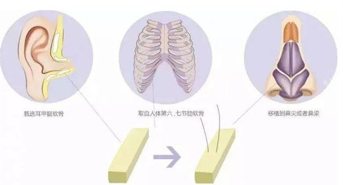 自体软骨隆鼻动画展示图