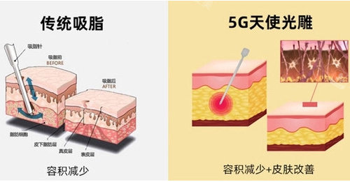 传统吸脂和5g天使光雕吸脂图 传统吸脂和5g天使光雕吸脂图