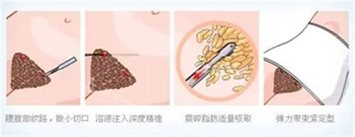 传统吸脂手术操作图 传统吸脂手术操作图