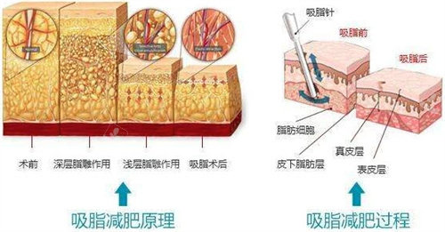 吸脂原理图 吸脂原理图