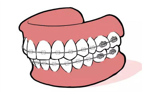 金屬牙齒矯正動畫圖