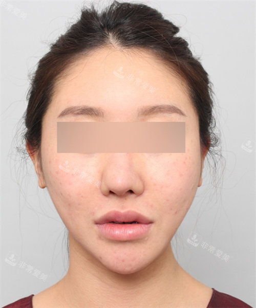 手術(shù)前照片 手術(shù)前照片