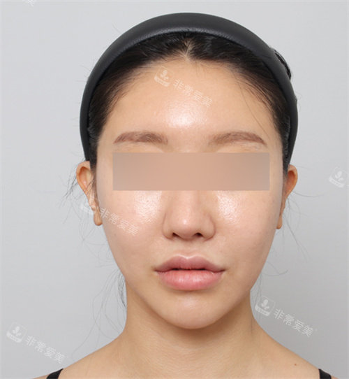 手術(shù)后照片 手術(shù)后照片