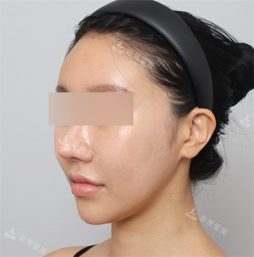 手術(shù)后照片 手術(shù)后照片