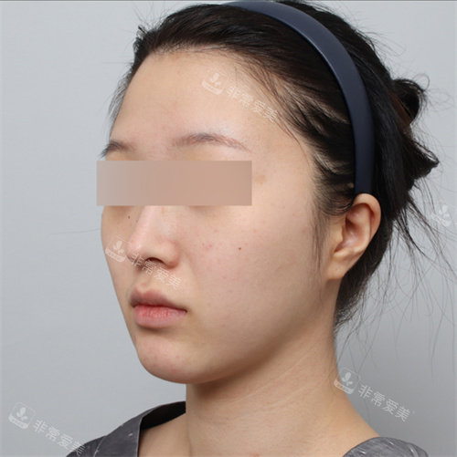 面部吸脂前照片 面部吸脂前照片