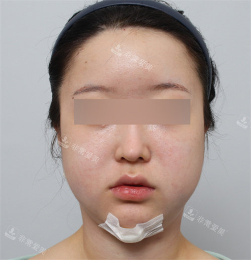 面部吸脂后照片 面部吸脂后照片