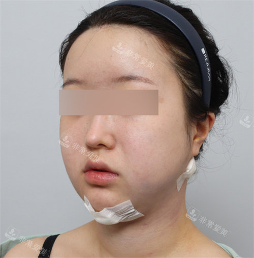 面部吸脂后照片 面部吸脂后照片