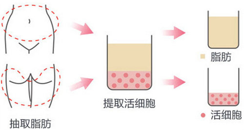 脂肪填充过量变成寿星公了怎么办，应该如何修复？