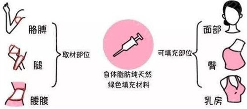 脂肪填充示意图